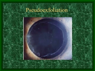 Pseudoexfoliation  