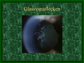 Glaucomaflecken 
