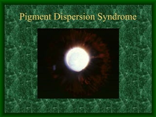 Pigment Dispersion Syndrome 
