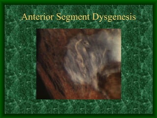 Anterior Segment Dysgenesis 