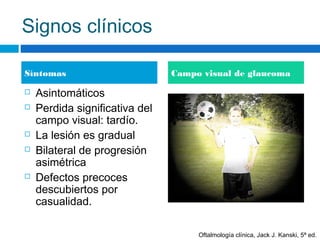 Signos clínicos

Síntomas                        Campo visual de glaucoma

   Asintomáticos
   Perdida significativa del
    campo visual: tardío.
   La lesión es gradual
   Bilateral de progresión
    asimétrica
   Defectos precoces
    descubiertos por
    casualidad.

                                     Oftalmología clínica, Jack J. Kanski, 5ª ed.
 