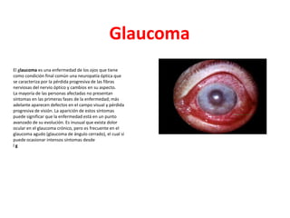 Glaucoma
El glaucoma es una enfermedad de los ojos que tiene
como condición final común una neuropatía óptica que
se caracteriza por la pérdida progresiva de las fibras
nerviosas del nervio óptico y cambios en su aspecto.
La mayoría de las personas afectadas no presentan
síntomas en las primeras fases de la enfermedad; más
adelante aparecen defectos en el campo visual y pérdida
progresiva de visión. La aparición de estos síntomas
puede significar que la enfermedad está en un punto
avanzado de su evolución. Es inusual que exista dolor
ocular en el glaucoma crónico, pero es frecuente en el
glaucoma agudo (glaucoma de ángulo cerrado), el cual sí
puede ocasionar intensos síntomas desde
lg
 
