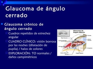 Glaucoma de ángulo
cerrado


Glaucoma crónico de
ángulo cerrado
 Cuadros

repetidos de estrechez

angular
 CUADRO CLÍNICO: visión borrosa
por las noches (dilatación de
pupila) / halos de colores
 EXPLORACIÓN: TO normales /
daños campimétricos

 
