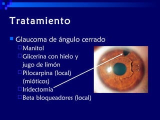 Tratamiento


Glaucoma de ángulo cerrado
 Manitol
 Glicerina

con hielo y
jugo de limón
 Pilocarpina (local)
(mióticos)
 Iridectomía
 Beta bloqueadores (local)

 