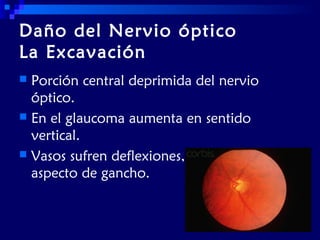 Daño del Nervio óptico
La Excavación
Porción central deprimida del nervio
óptico.
 En el glaucoma aumenta en sentido
vertical.
 Vasos sufren deflexiones,
aspecto de gancho.


 