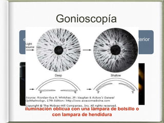 Glaucoma de angulo cerrado y abierto | PPTX