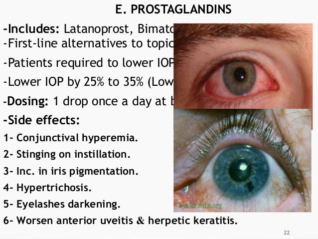 Glaucoma Latanoprost Side Effects - Astigmatism Glaucoma Swollen Eyes Disease Glaucoma Latanoprost Side Effects - Astigmatism Glaucoma Swollen Eyes Disease
