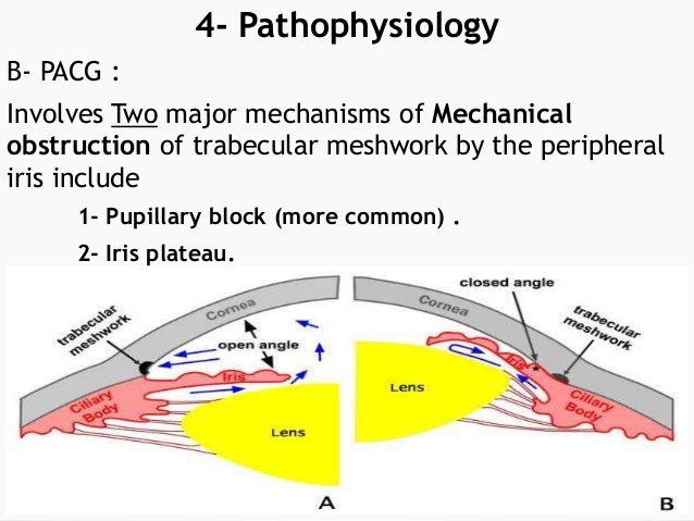 of disease 7 mechanisms Glaucoma of disease 7 mechanisms Glaucoma