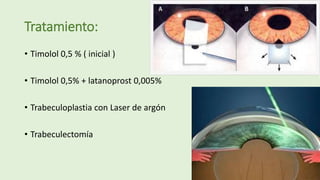 Tratamiento:
• Timolol 0,5 % ( inicial )
• Timolol 0,5% + latanoprost 0,005%
• Trabeculoplastia con Laser de argón
• Trabeculectomía
 