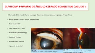 GLAUCOMA PRIMARIO DE ÁNGULO CERRADO CONGESTIVO ( AGUDO ):
- Obstrucción del drenaje del humor acuoso por el cierre parcial o completo del ángulo por el iris periférico.
- Ángulo oclusivo y cámara anterior poco profunda
- Dolor ocular súbita
- Halos cuando mira a la luz
- Aumento PIO ( 50-60 mmHg )
- Nauseas / Vómitos
- Pupila en ligera midriasis
- Hiperemia Conjuntival
 