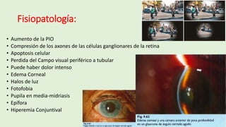 Fisiopatología:
• Aumento de la PIO
• Compresión de los axones de las células ganglionares de la retina
• Apoptosis celular
• Perdida del Campo visual periférico a tubular
• Puede haber dolor intenso
• Edema Corneal
• Halos de luz
• Fotofobia
• Pupila en media-midriasis
• Epífora
• Hiperemia Conjuntival
 