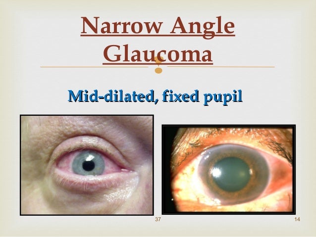 single fixed dilated pupil