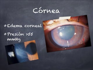 Córnea
Edema corneal
Presión >55
mmHg
 