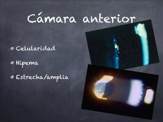 Cámara anterior
Celularidad
Hipema
Estrecha/amplia
 