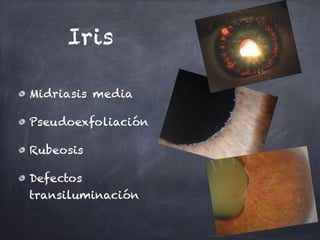 Iris
Midriasis media
Pseudoexfoliación
Rubeosis
Defectos
transiluminación
 