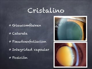 Cristalino
Glaucomfleken
Catarata
Pseudoexfoliacion
Integridad capsular
Posición
 