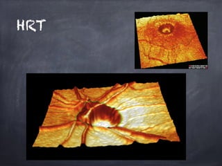 HRT
 