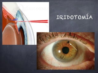 IRIDOTOMÍA
 