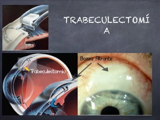 TRABECULECTOMÍ
A
 
