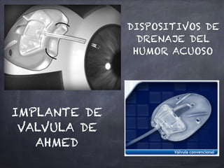IMPLANTE DE
VALVULA DE
AHMED
DISPOSITIVOS DE
DRENAJE DEL
HUMOR ACUOSO
 