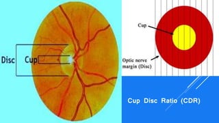 Disc Measurement Glaucoma | PPTX