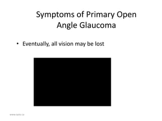 www.opto.ca
Symptoms of Primary Open
Angle Glaucoma
• Eventually, all vision may be lost
 