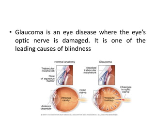 • Glaucoma is an eye disease where the eye’s
optic nerve is damaged. It is one of the
leading causes of blindness
 