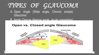 TYPES OF GLAUCOMA
A. Open Angle (Wide angle, Chronic simple)
Glaucoma
B. Angle Closure (Narrow angle, Acute congestive)
Glaucoma
8
 