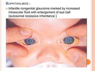 BUPHTHALMOS :
 Infantile congenital glaucoma marked by increased
intraocular fluid with enlargement of eye ball
{autosomal recessive inheritance }
 