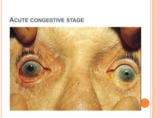 ACUTE CONGESTIVE STAGE
 