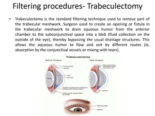 Filtering procedures- Trabeculectomy
• Trabeculectomy is the standard filtering technique used to remove part of
the trabecular meshwork. Surgeon used to create an opening or fistula in
the trabecular meshwork to drain aqueous humor from the anterior
chamber to the subconjunctival space into a bleb (fluid collection on the
outside of the eye), thereby bypassing the usual drainage structures. This
allows the aqueous humor to flow and exit by different routes (ie,
absorption by the conjunctival vessels or mixing with tears).
 