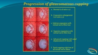 glaucoma-pptx