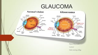 GLAUCOMA
Shyam Bhatewara
Lecturer
Index nursing college
 