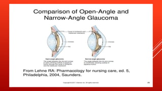Glaucoma | PPTX