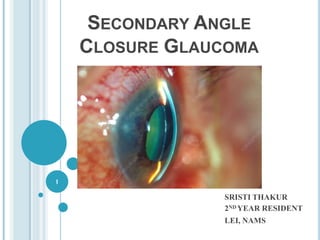 SECONDARY ANGLE
CLOSURE GLAUCOMA
SRISTI THAKUR
2ND YEAR RESIDENT
LEI, NAMS
1
 