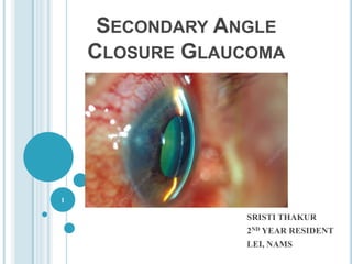 SECONDARY ANGLE
CLOSURE GLAUCOMA
SRISTI THAKUR
2ND YEAR RESIDENT
LEI, NAMS
1
 