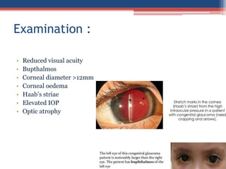 • Reduced visual acuity
• Bupthalmos
• Corneal diameter >12mm
• Corneal oedema
• Haab’s striae
• Elevated IOP
• Optic atrophy
Examination :
 