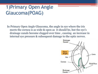 In Primary Open Angle Glaucoma, the angle in eye where the iris
meets the cornea is as wide & open as it should be, but the eye’s
drainage canals become clogged over time , causing an increase in
internal eye pressure & subsequent damage to the optic nerves.
1)Primary Open Angle
Glaucoma(POAG)
 