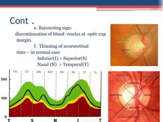 e. Bayoncting sign-
discontinuation of blood vescles at optic cup
margin.
f. Thinning of neuroretinal
rims – in normal case
Inferior(I) > Superior(S)
Nasal (N) > Temporal(T)
Cont .
 