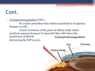 • Cyclophotocoagulation (CPC) :
It’s a laser procedure that reduces production of aqueous
humour in CPC .
A laser to destroy of the parts of cilliary body which
products aqueous humour if successful this will reduce the
production of fluid &
decreasing the IOP in eyes .
Cont.
 