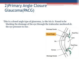 This is a closed angle type of glaucoma, i.e the iris is Found to be
blocking the drainage of the eye through the trabecular meshwork &
the eye pressure to rise .
2)Primary Angle Closure
Glaucoma(PACG)
 