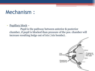 • Pupillary block –
Pupil is the pathway between anterior & posterior
chamber, if pupil is blocked than pressure of the pos. chamber will
increase resulting bulge out of iris ( iris bombe) .
Mechanism :
 