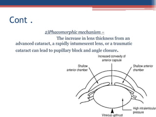2)Phacomorphic mechanism –
The increase in lens thickness from an
advanced cataract, a rapidly intumescent lens, or a traumatic
cataract can lead to pupillary block and angle closure.
Cont .
 