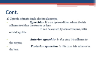 4) Chronic primary angle closure glaucoma
• Synechia - It is an eye condition where the iris
adheres to either the cornea or lens.
It can be caused by ocular trauma, iritis
or iridocyclitis.
• Anterior synechia- in this case iris adheres to
the cornea.
• Posterior synechia- in this case iris adheres to
the lens.
Cont.
 