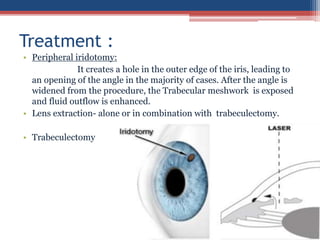• Peripheral iridotomy:
It creates a hole in the outer edge of the iris, leading to
an opening of the angle in the majority of cases. After the angle is
widened from the procedure, the Trabecular meshwork is exposed
and fluid outflow is enhanced.
• Lens extraction- alone or in combination with trabeculectomy.
• Trabeculectomy
Treatment :
 