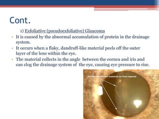1) Exfoliative (pseudoexfoliative) Glaucoma
• It is caused by the abnormal accumulation of protein in the drainage
system.
• It occurs when a flaky, dandruff-like material peels off the outer
layer of the lens within the eye.
• The material collects in the angle between the cornea and iris and
can clog the drainage system of the eye, causing eye pressure to rise.
Cont.
 