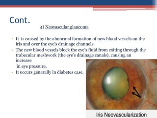 4) Neovascular glaucoma
• It is caused by the abnormal formation of new blood vessels on the
iris and over the eye's drainage channels.
• The new blood vessels block the eye’s fluid from exiting through the
trabecular meshwork (the eye’s drainage canals), causing an
increase
in eye pressure.
• It occurs generally in diabetes case.
Cont.
 