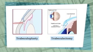 Trabeculoplasty Trabeculectomy
 