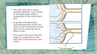 • The optic disc has a center
portion called the "cup" which
is normally quite small in
comparison to the entire optic
disc.
• In people with glaucoma,
increased pressure in the eye
and/or loss of blood flow to the
optic nerve causes the nerve
fibers to die.
• This causes the cup to become
larger in comparison to the
optic disc (increased cup: disc
ratio).
 