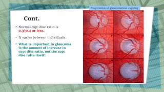 Cont.
• Normal cup: disc ratio is
0.30.4 or less.
• It varies between individuals.
• What is important in glaucoma
is the amount of increase in
cup: disc ratio, not the cup:
disc ratio itself!
Progression of glaucomatous cupping
 